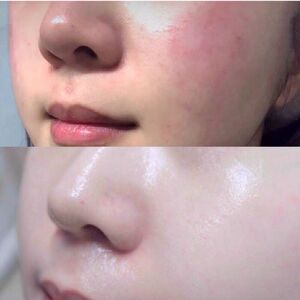 敏感肌肤护肤品套装去红血丝专用水乳屏障防过敏性皮肤修复受损女