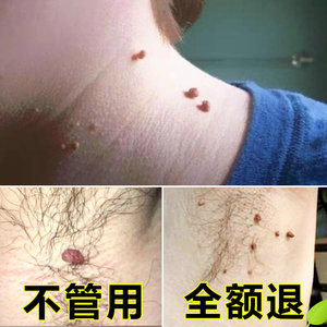 瘊疣平正品鱼鳞疣去尤除疣灵肉刺瘊子去除膏趾疣跖疣膏足部疣瘊净