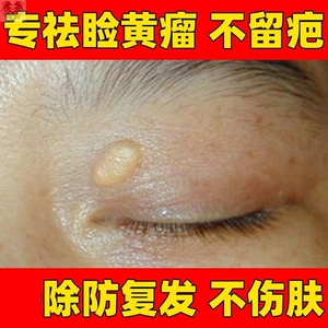 去除睑黄疣药膏眼部祛黄色瘤圆脸黄斑黄睑瘤康脸部睑黄瘤膏专用膏