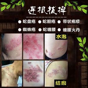 生殖防复发男器疱疹外阴女性hsv2泡疹病毒断根克星日本私处药膏