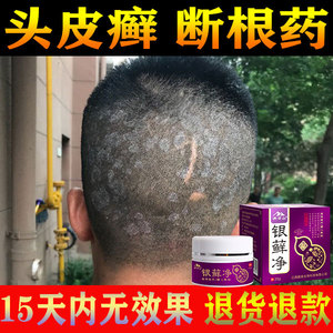 头皮癣药膏真菌感染头部专用治疗牛皮癣皮肤干燥瘙痒特效断根藓药