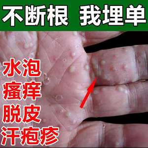 汗疱疹油手藓癣药膏真菌感染湿疹手脱皮手部克星治疗手上水泡手部