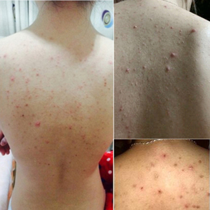 背部胸前口祛痘痘印去除螨虫神器脖子前胸后背身上长痘痘粉刺喷雾