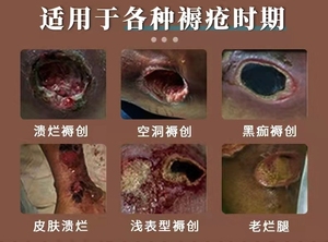 红伤膏