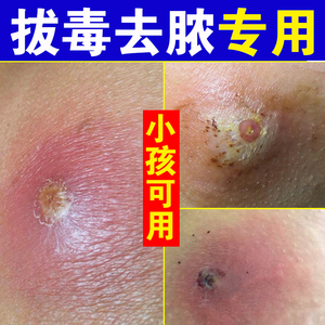 淘宝 正品拔毒膏拔脓贴膏火疖子坐板疮戒子草本毒疮吸脓贴硬块痘短
