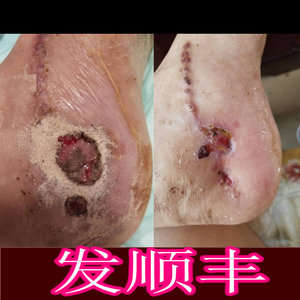 擦伤外伤烫伤消炎促进长肉伤口结痂快速愈合老烂腿专生肌散止血粉