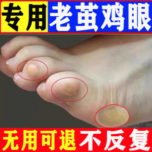 跌倒的小黄牛淘宝祛老茧脚茧手脚趾脚底死皮关节茧去根软化剂去除