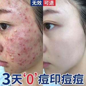 祛痘痘印痘坑修复膏男生非红肿消炎凝胶淡化去痘疤凹洞男士女正品
