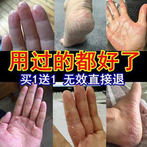 治疗手癣藓真菌感染脱皮干裂手部鹅掌风手指开裂裂口湿疹止痒药膏