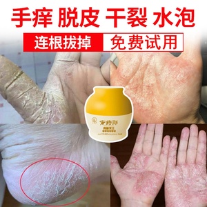 治疗手上起小水泡手指脱皮湿疹手癣开裂真菌感染干裂裂口止痒药膏