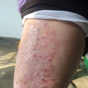 皮肤干痒身上冬天小腿干燥起皮藓瘙痒冬季身体治痒药全身止痒抑菌