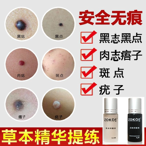 点痣水无痕正品脸部去痔祛斑点痦子祛痣膏除痣中药黑志黑点神器笔