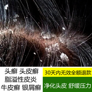 脂溢性皮炎头皮癣银屑病头部牛皮癣外用药膏治疗去头屑止痒洗发水