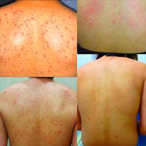 除后背部祛痘除螨虫黑头去背上身上胸口痘痘神器喷雾祛背后长粉刺