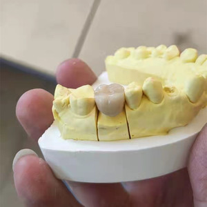 假牙全瓷牙固定