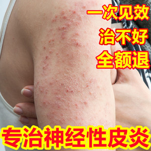 治疗神经性皮炎去根除外用膏湿疹日光溢脂性紫外线过敏止痒专用药