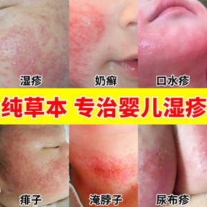 湿疹婴儿专用儿童奶藓膏口水疹婴幼儿热疹宝宝霜皮肤治疗止痒去根
