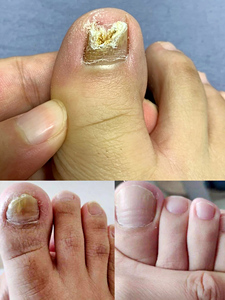 【买2送1】美康净灰甲抑菌液脱甲金油灰指甲净套装脚趾指甲修复液