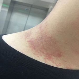 tb095600309737淘宝大腿烧裆淹了潮湿痛胖人腿根不透气烧裆真菌感染