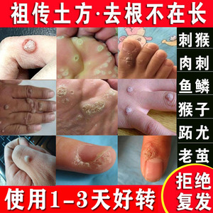 去猴子肉粒疙瘩鱼鳞痣瘊子休子药脚肉刺猴专用药手足部去除膏正品