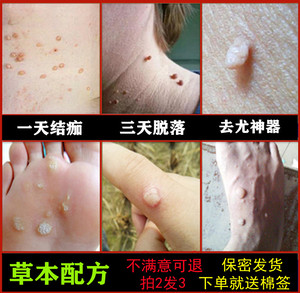 去除脚底猴子疙瘩颈部腋下脖子小肉球丝状尤刺猴肉瘤痣正品克尤液