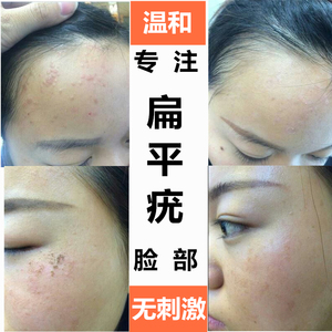 扁平疣去除膏正品脸部点除手部草本抑菌乳膏治疗扁平疣的药膏日本