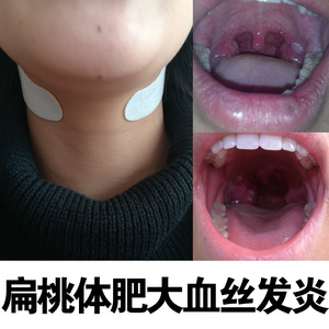 咽扁贴小儿扁桃体发炎肥大肿大炎儿童成人急慢性咽喉肿痛扁桃体贴