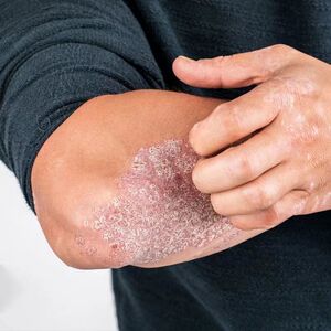 牛皮藓银屑病癣股癣手足头皮癣疹湿止痒去老根专用疗治特效药膏