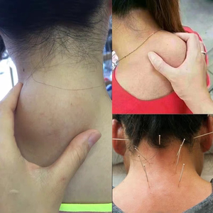 小红书热推正品富贵包消除贴颈椎疏通按摩神器鼓包矫正器肩颈贴