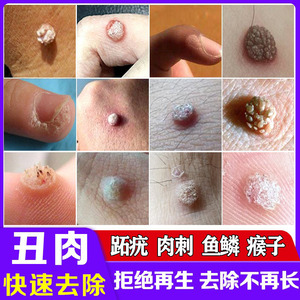 去猴子的药正品肉粒疙瘩鱼鳞痣跖疣膏治瘊子药脚肉刺猴专用药足部