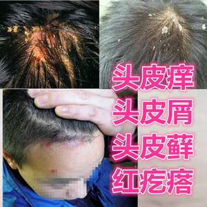 头皮癣头部牛皮癣药膏抑菌止痒皮肤外用成人湿疹毛囊炎真菌感染