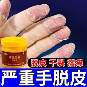 手脱皮药膏手指手上起皮干燥蜕皮掉皮严重开裂真菌感染手癣汗泡膏