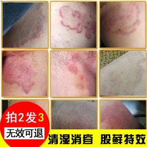 屁股两边蛋蛋痒藓膏手足头大腿内侧屁眼脚痒水泡脱皮烂脚丫止痒膏