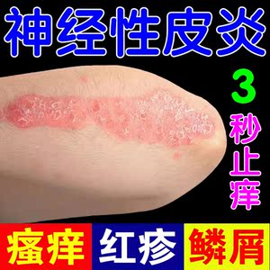 神经性皮炎膏无激素