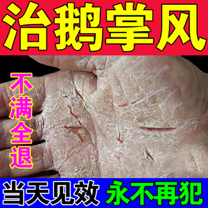 鹅掌风药膏治疗手裂的药膏干裂脱皮鹅掌风真菌感染手足癣止痒去根