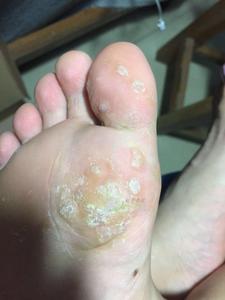 清脚尤手足趾跖尤立净拔肉刺去除猴子疣必清脚趾脱尤膏药疙瘩疣粒