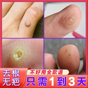 3016人付款淘宝血胞刺去除膏脚血泡刺贴神器老鼠痣鱼鳞痣去鱼休子的药