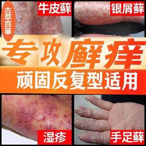 黑1白癣药水癣根除紫椒癣町去王麻1氏牛皮藓癣仁1振草本祛癣止痒