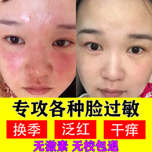 脸上过敏药脸部