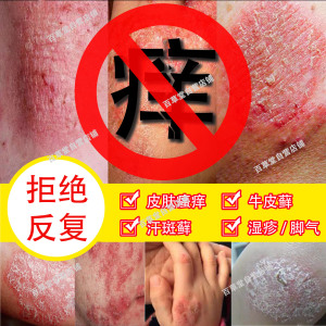 凡士林药用皮肤百草安柠舒灵银病头皮癣特效癣药膏玉柠红膏康屑沣