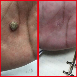 跖瘊子疣灵刺瘊子刺猴甲周疣病毒性软疣手足疣趾疣拓疣去灵疣