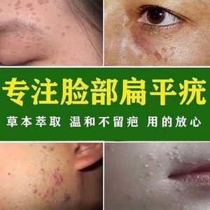去扁平疣面部专用药膏去除丝状疣瘊子寻常疣足部跖疣鸡眼肉粒神器