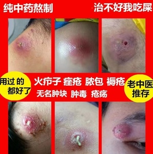 火疖子拔毒膏