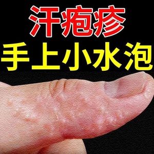 手癣膏真菌感染脱皮干裂去根药膏汗状疱疹手上起小水泡鹅掌风药膏