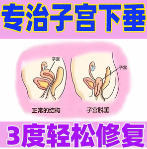 子宫下垂托盆底肌修复产后膨出漏尿贴中老年子宫下垂提升托训练器