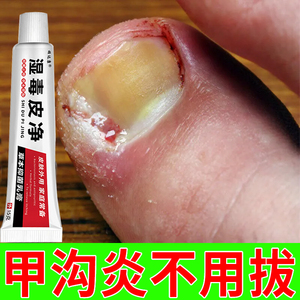 甲沟炎治疗专用药膏软甲消肿去肉芽嵌甲非矫正器指甲往肉里长外用