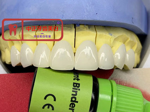 义获嘉超薄美白瓷贴面vita琥珀瓷全瓷贴片牙齿贴面牙缝修复烤瓷牙