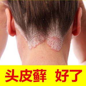 李氏百草膏头皮藓药头皮癣专用银屑癣外用真菌感染牛皮癣头癣头部