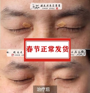 睑草本修护膏去除眼部睑黄瘤膏睑黄疣祛汗管眼皮脸黄斑瘤去除圆