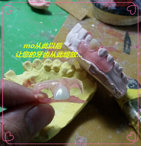生产隐形义齿 树脂活动假牙 加工隐形牙假牙义齿活动牙包邮
